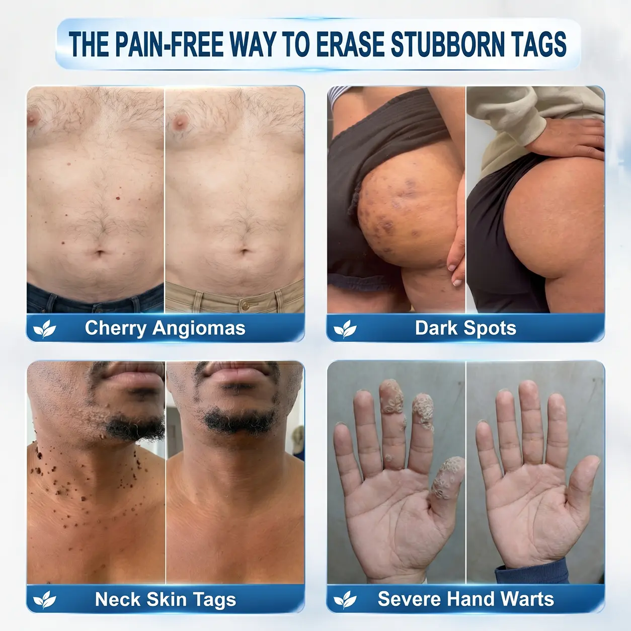 Coredewยฎ ๐-๐๐๐ ๐๐ธ๐ข๐ง ๐๐๐ด & ๐๐ฉ๐ค๐ญ ๐๐ซ๐๐ฌ๐๐ซ Painless & Scar-Free Advanced Imperfection Removal Rollerball Pen