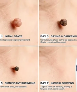 Coredewยฎ ๐-๐๐๐ ๐๐ธ๐ข๐ง ๐๐๐ด & ๐๐ฉ๐ค๐ญ ๐๐ซ๐๐ฌ๐๐ซ Painless & Scar-Free Advanced Imperfection Removal Rollerball Pen