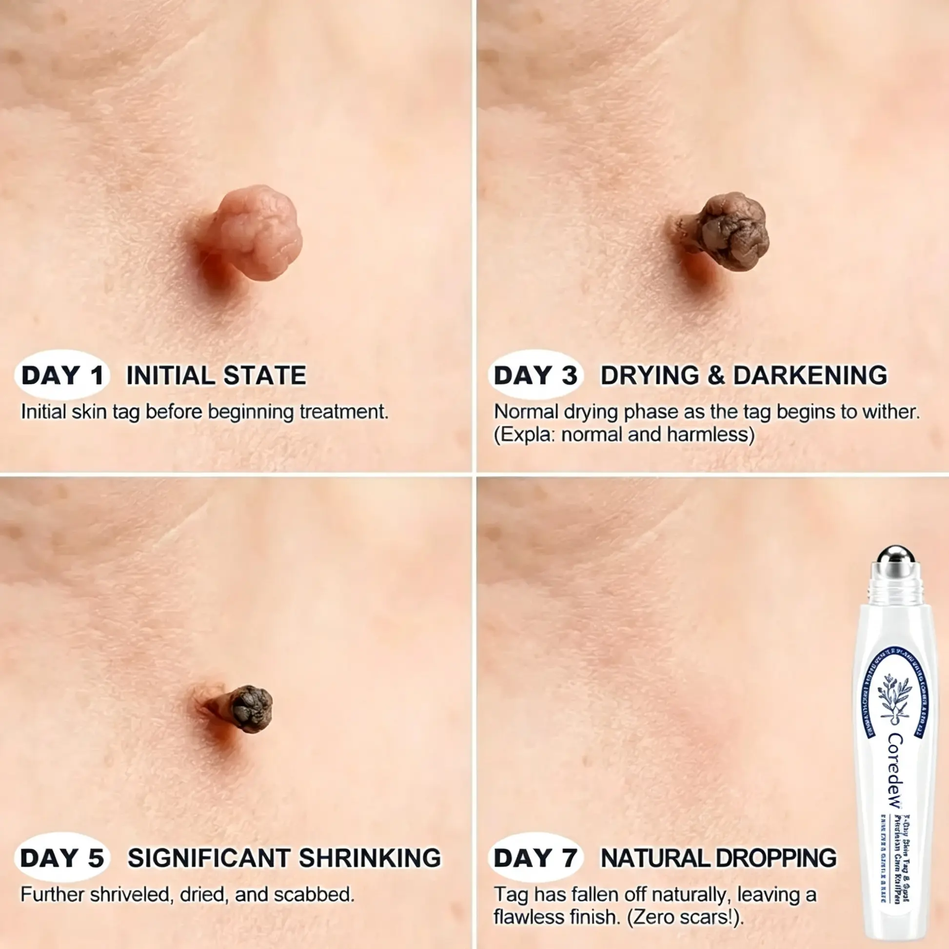Coredewยฎ ๐-๐๐๐ ๐๐ธ๐ข๐ง ๐๐๐ด & ๐๐ฉ๐ค๐ญ ๐๐ซ๐๐ฌ๐๐ซ Painless & Scar-Free Advanced Imperfection Removal Rollerball Pen