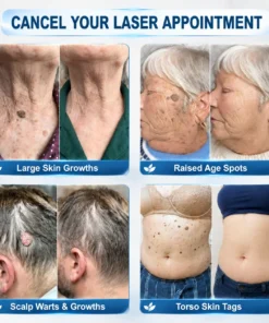Coredewยฎ ๐-๐๐๐ ๐๐ธ๐ข๐ง ๐๐๐ด & ๐๐ฉ๐ค๐ญ ๐๐ซ๐๐ฌ๐๐ซ Painless & Scar-Free Advanced Imperfection Removal Rollerball Pen