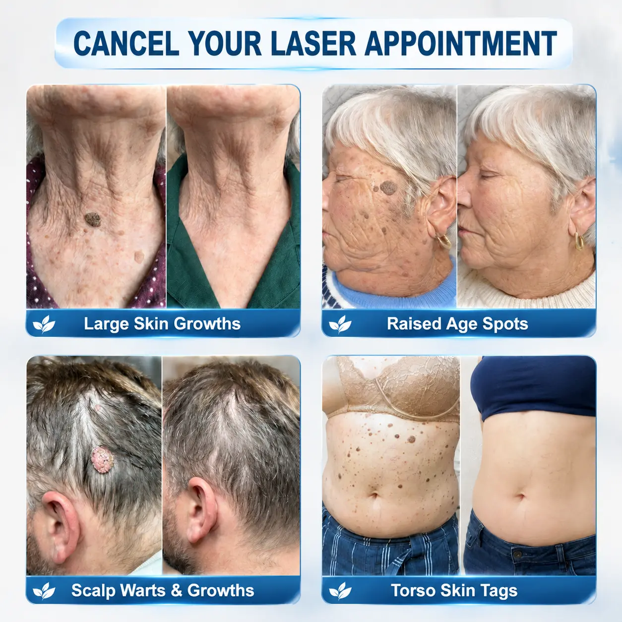 Coredewยฎ ๐-๐๐๐ ๐๐ธ๐ข๐ง ๐๐๐ด & ๐๐ฉ๐ค๐ญ ๐๐ซ๐๐ฌ๐๐ซ Painless & Scar-Free Advanced Imperfection Removal Rollerball Pen