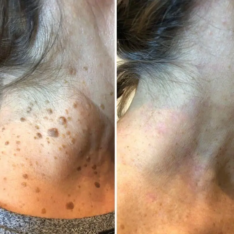 Coredew® ChillErase Bump Renewal Spray