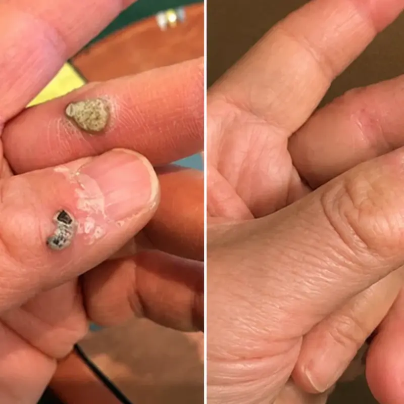 Coredew®2-in-1 Microneedle & Hydrocolloid Patch