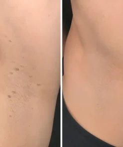 Coredew®2-in-1 Microneedle & Hydrocolloid Patch