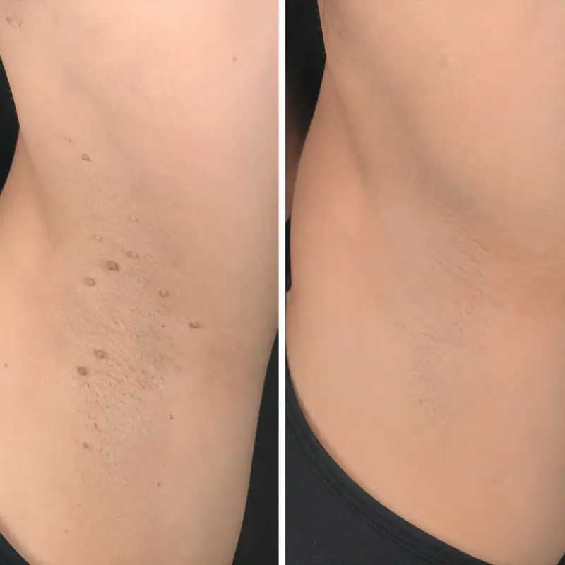 Coredew®2-in-1 Microneedle & Hydrocolloid Patch